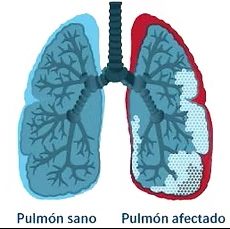 Fibrosis Pulmonar