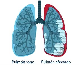 Fibrosis Pulmonar